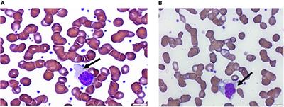 Peripheral blood cell anomalies in COVID-19 patients in the United Arab Emirates: A single-centered study